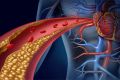 Hipercolesterolemia Familiar pode aumentar em 30 vezes o risco de problemas cardíacos